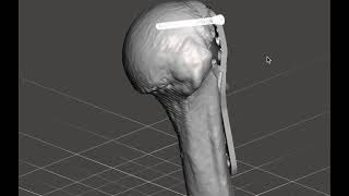 Planejamento 3D fratura úmero proximal - 3D Planning of Proximal Humeral Fracture