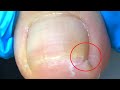 Inflamed ingrown toenail dug deep into toe! #Pedicure