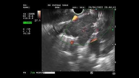 EUS Guided Mediastinal Lymph node Biopsy: Procedure and Benefits - Mission Gastro Hospital