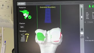 MAKO Robotic Assisted Knee Surgery