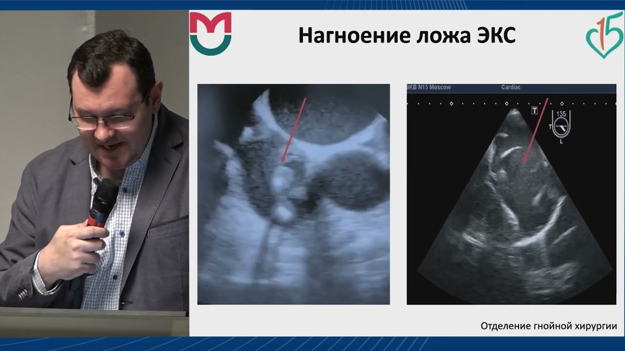 Инфекционный эндокардит в многопрофильном стационаре. Дорошенко Д.А.