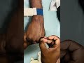 Scalp Vein Set Insertion technique | S V Set Insertion | I V Injection #injection #reels #iv #shorts