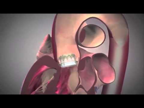 Transcaval TAVR Performed at Oklahoma Heart Institute