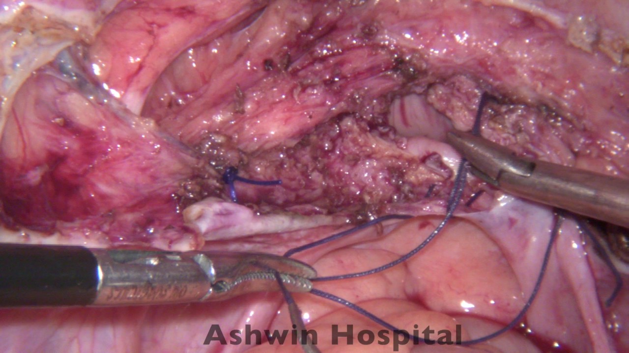 camera iphone 8 plus apk Vault closure after TLH (Totally Laparoscopic Hysterectomy)