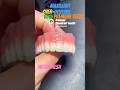 Max. Denture with metal mesh#dentist#cesar#dental#satisfying#shorts#fyp#parati#viral#reels#yt#tpd#dt
