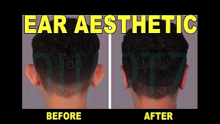 Ear Aesthetics | All About Otoplasty | Before and After | Leyla Arvas, MD