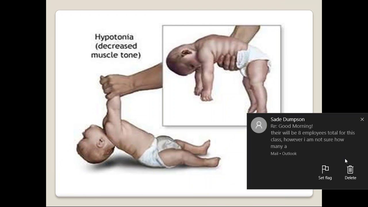 Living with Prader Willi Syndrome October 18, 2017 YouTube