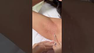 #pdo #pdothread #pdothreadlift #hilospdo #pdothreads #pdofacelift #rellenodelabios #lipaugmentation