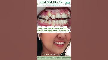 Niềng răng chen chúc trước và sau tại nha khoa AVA TpHCM #niengrang #niềngrăngtrongsuốt