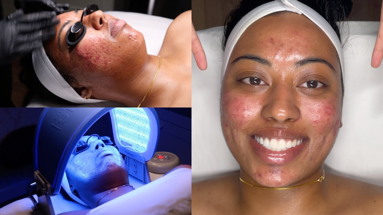 CYSTIC ACNE FACIAL TREATMENT PHYLA 3STEP ACNE SYSTEM PRO TIPS FOR