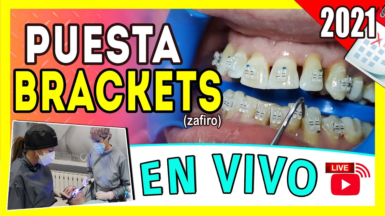 [🔴 En Vivo] Como se 𝗣𝗢𝗡𝗘𝗡 𝗟𝗢𝗦 𝗕𝗥𝗔𝗖𝗞𝗘𝗧𝗦 por PRIMERA VEZ INSTALACIÓN de