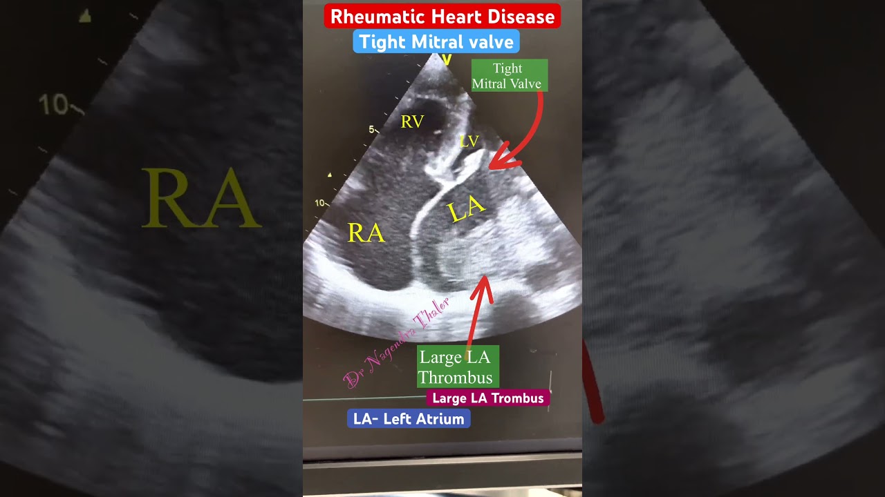 Large Left Atrial Thrombus in Echo l हार्ट इको टेस्ट 