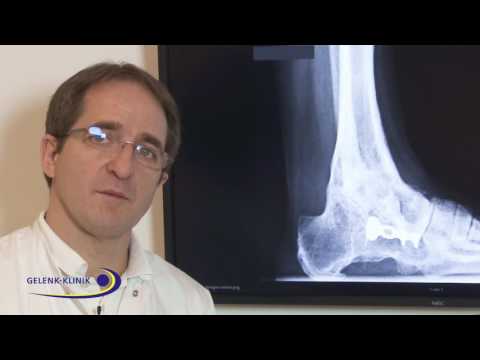 Video: Arthrose Des Sprunggelenks