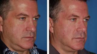 Revision Rhinoplasty Seattle - Rhinoplasty Redo screenshot 4