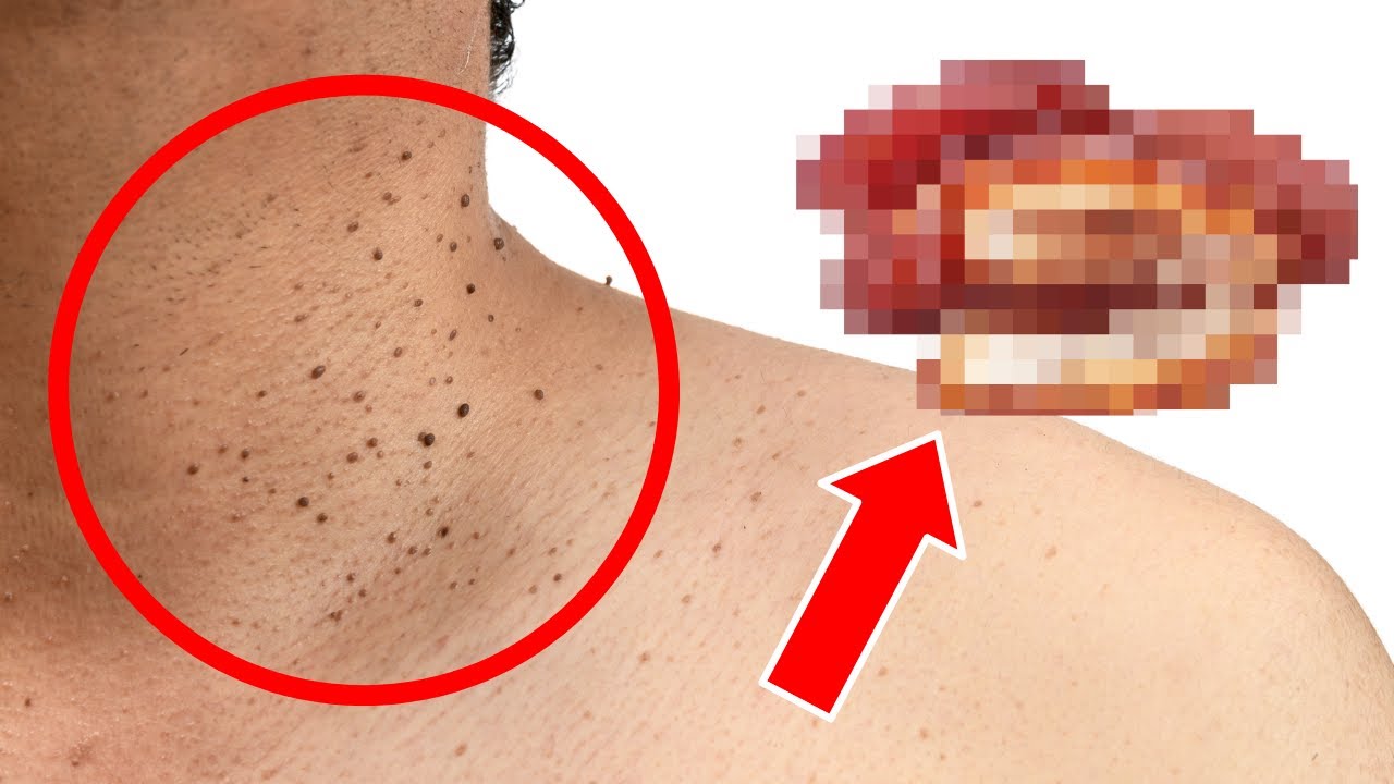 One Common Food That's Secretly Causing Your Skin Tags