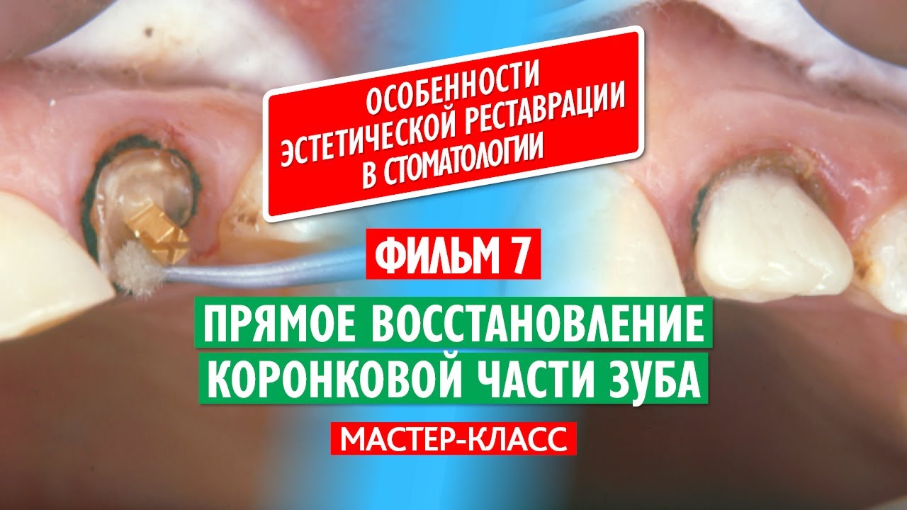 Фильм 7. Прямое восстановление коронковой части зуба. - YouTube