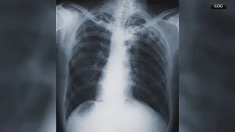 Kansas facing largest recorded tuberculosis outbreak in U.S. since the 1950s