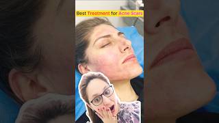How to get rid of acne scars with simple fix | acne treatment | Tips | Jason emer skincare shorts