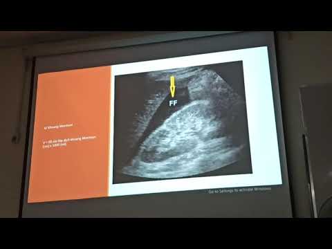 Video Siêu âm đánh giá dịch ổ bụng. Dr Cường. 23/07/2020. - youtube