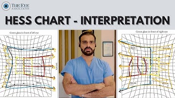 Hess Chart - Interpretation