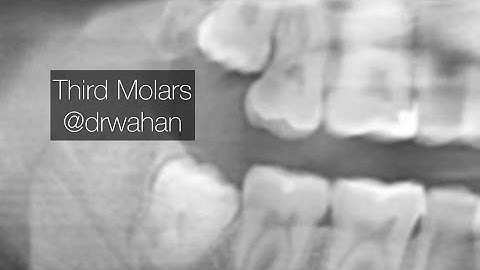 Third Molar Surgery Step by Step Extraction Video