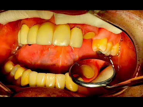 Quick and Easy fabrication of Temporary bridge - [Dr. Na Kiwon] 