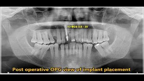 Endodontically failed upper central incisor extraction & immediate loading of Basal implants