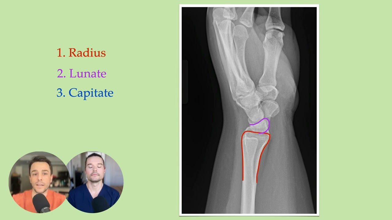 Lunate vs Perilunate Dislocation - ALL YOU NEED TO KNOW