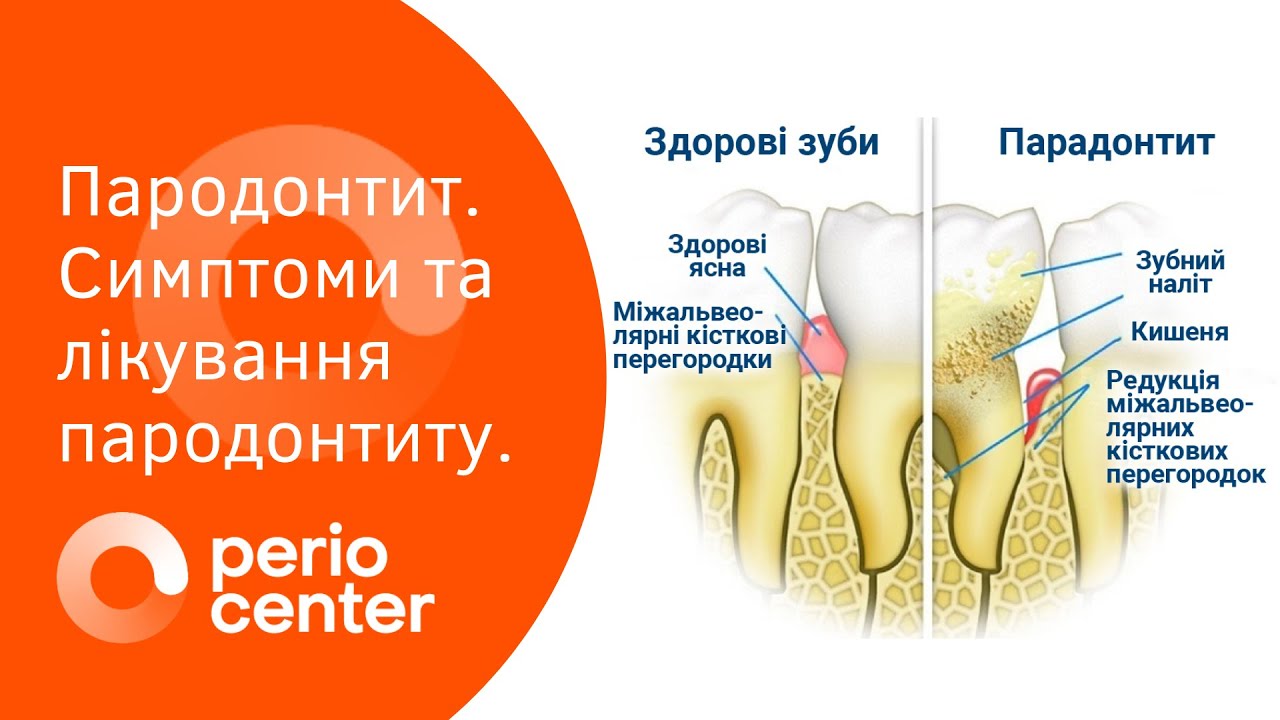 Пародонтит. Симптоми та лікування пародонтиту | клініка Perio Center ...