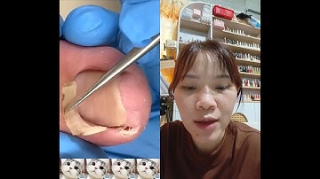 Móng mọc ngược - khoé móng #reaction #shortvideo #nails #nailart #laykhoe