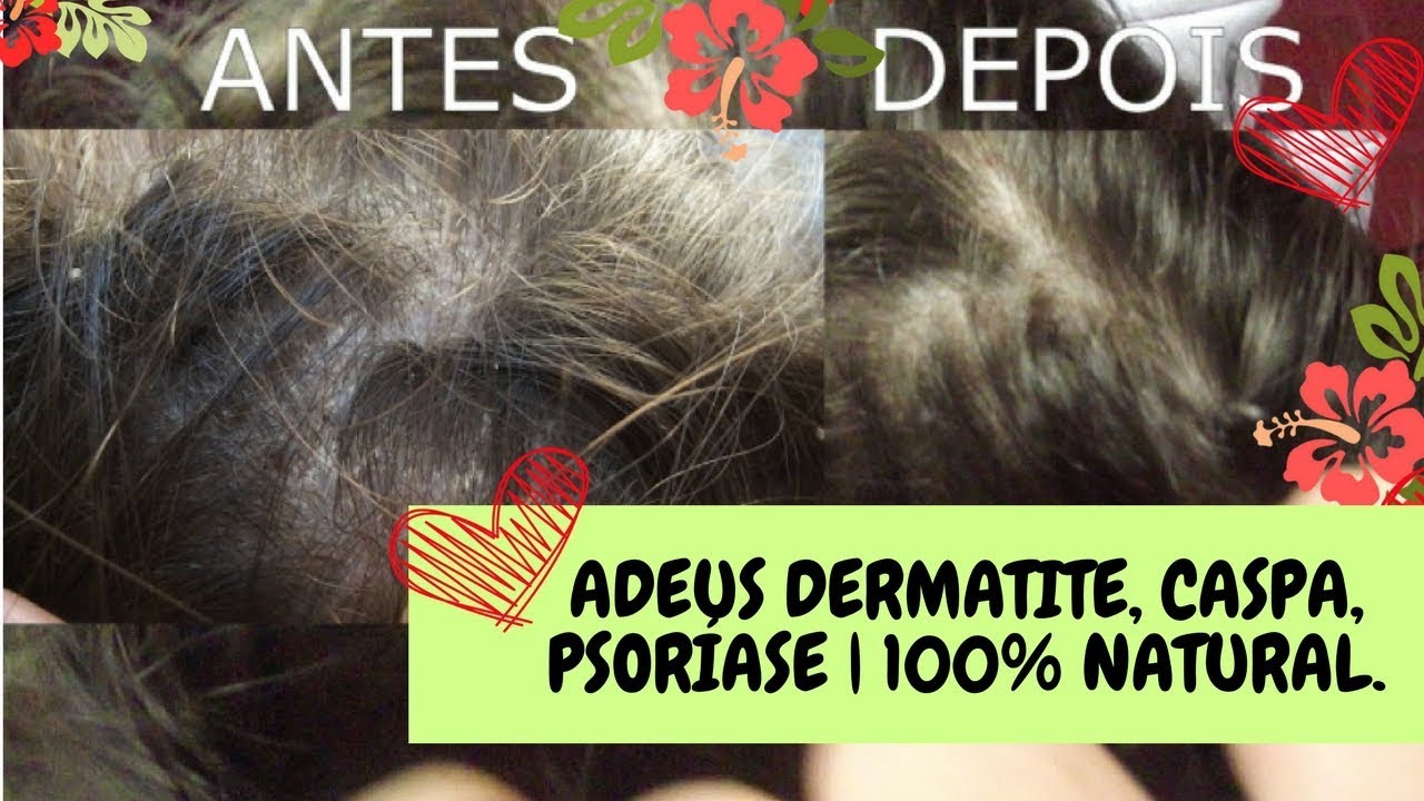 Receita Caseira 100 Natural Adeus Dermatite Caspa Psoriase E