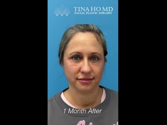 Upper and Lower Eyelid Surgery: The Healing ProcessThuy-Van Tina Ho, MD