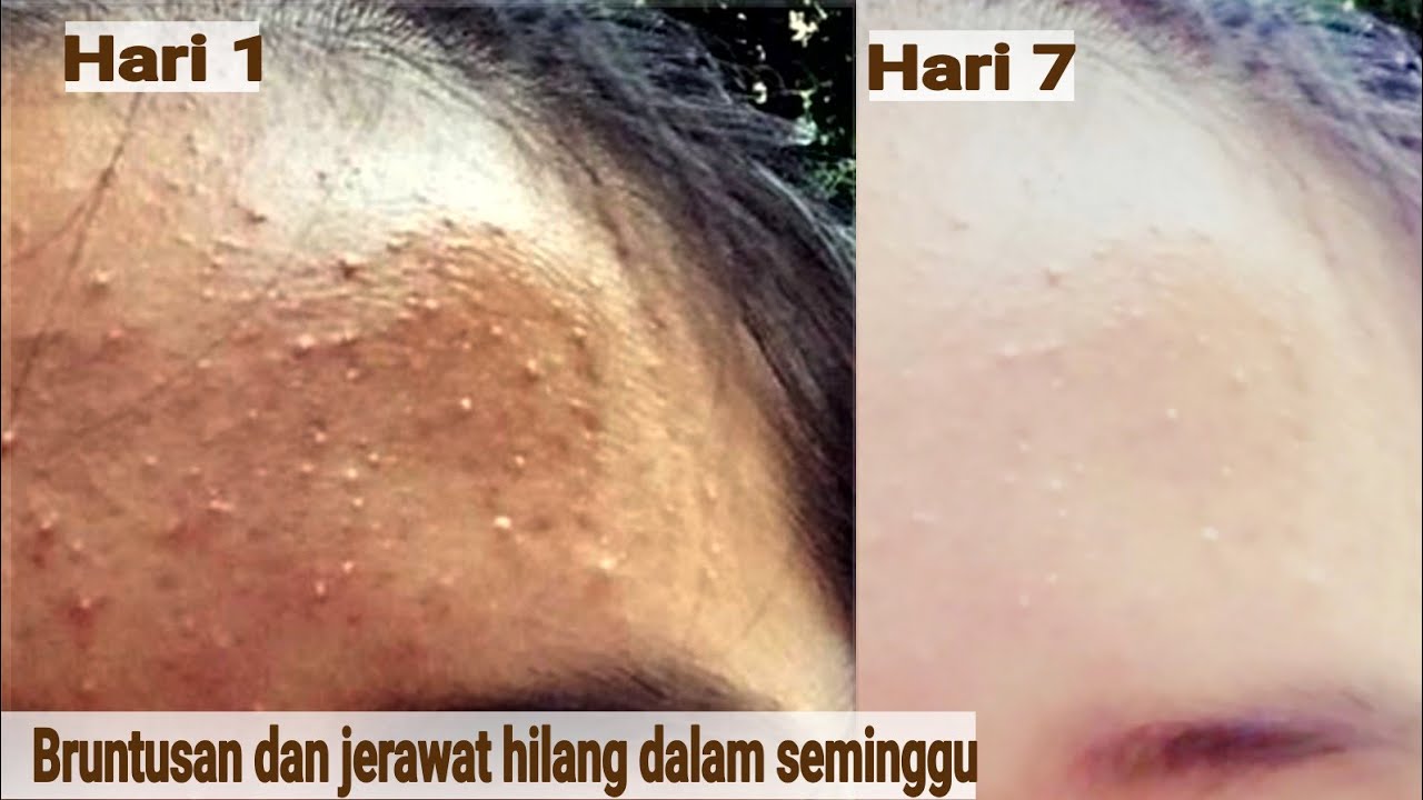 Bruntusan dan jerawat hilang dalam seminggu, bonus wajah jadi putih