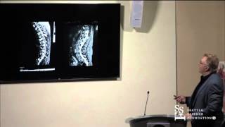 DFINE Case Studies by James Carlisle, MD