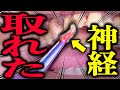 若返るため 前歯の神経とりました