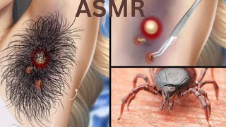 Armpit shaving by straight razor | Yeast infection armpit | #treatments #health #asmr #medical