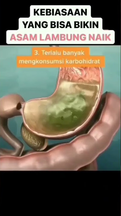 Penyebab asam lambung naik | Kebiasaan mana yang tidak bisa dihindari?