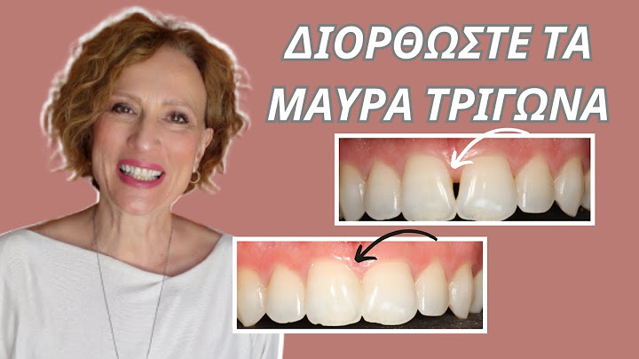 Κενά στα δόντια. Πως κλείνει το μαύρο τρίγωνο;