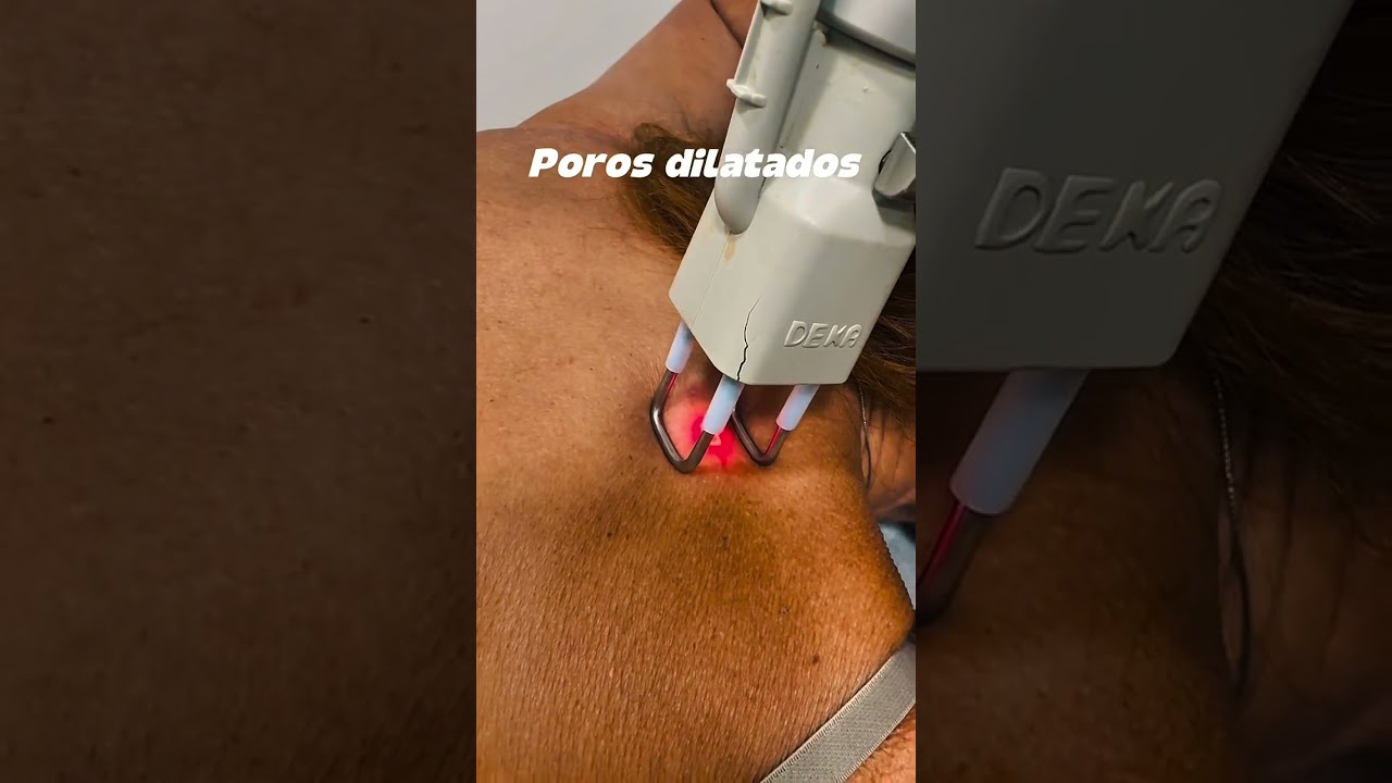 Laser de CO2 fracionado