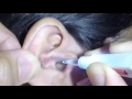 Woman's Massive Amount of Nasty Earwax Extraction