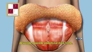 Abdominoplastia Dr Thiago Belfort Recife PE