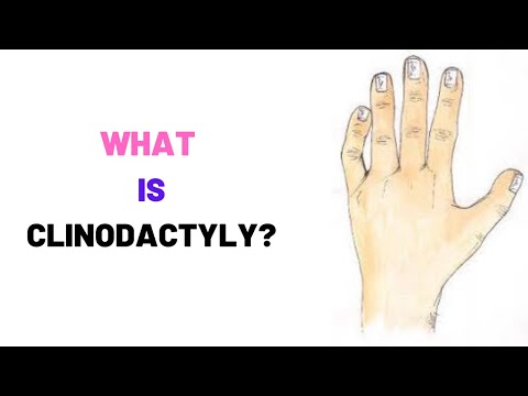 Video: Clinodactyly: Definitie, Afbeeldingen, Behandeling, Chirurgie En Meer