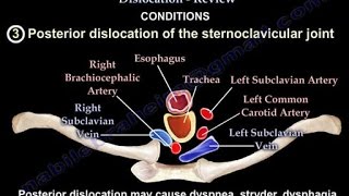 Sternoclavicular Joint Dislocation Review - Everything You Need To Know - Dr. Nabil Ebraheim