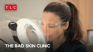 Pustular Rosacea The Bad Skin Clinic Tlc Southeast Asia