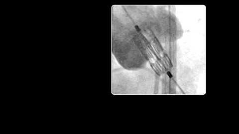 Valve Deployment Via Fluroscopy