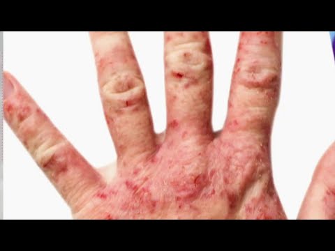 Vidéo: Comment Une Obsession Avec Le Lavage Des Mains A Aggravé Mon Eczéma