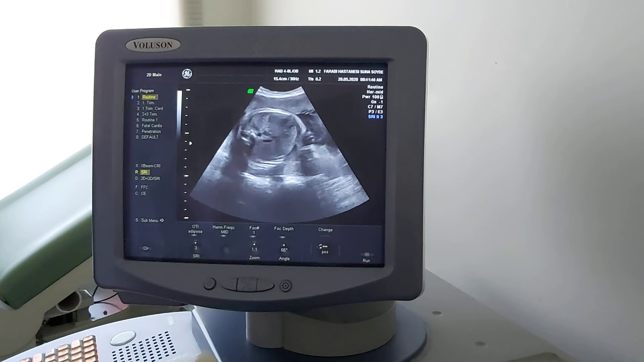 KIZ MI ? ERKEK Mİ ? (Ultrason görüntülerinde bebek KIZ MI ? ERKEK Mİ ? (Ultrason görüntülerinde bebek