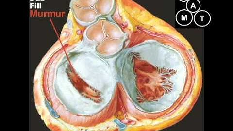 Animated Mitral Stenosis Murmur