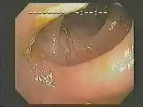 colon hydrotherapy detoxification youtube how colon cleansing works