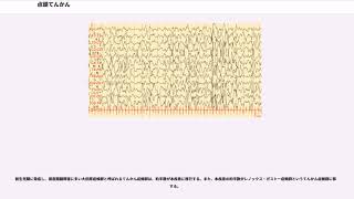 点頭てんかん